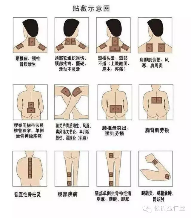 用侯氏益仁堂膏药贴敷图解